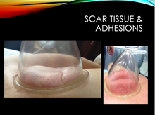 Moving Cupping for CT Release (Live Seminar) / West Palm Beach, FL (12 CEUs) / August 23, 2025