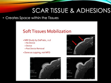 Moving Cupping for CT Release (Live Seminar) / West Palm Beach, FL (12 CEUs) / August 23, 2025