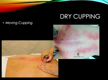 Moving Cupping for CT Release (Live Seminar) / West Palm Beach, FL (12 CEUs) / August 23, 2025