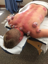 Static Cupping (Add-On-Only)