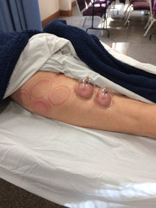 Static Cupping (Add-On-Only)
